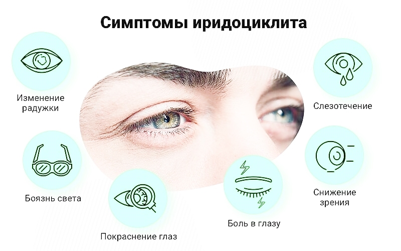 Иридоциклит