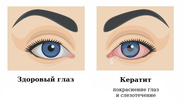 Кератит. Классификация