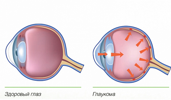 Глаукома